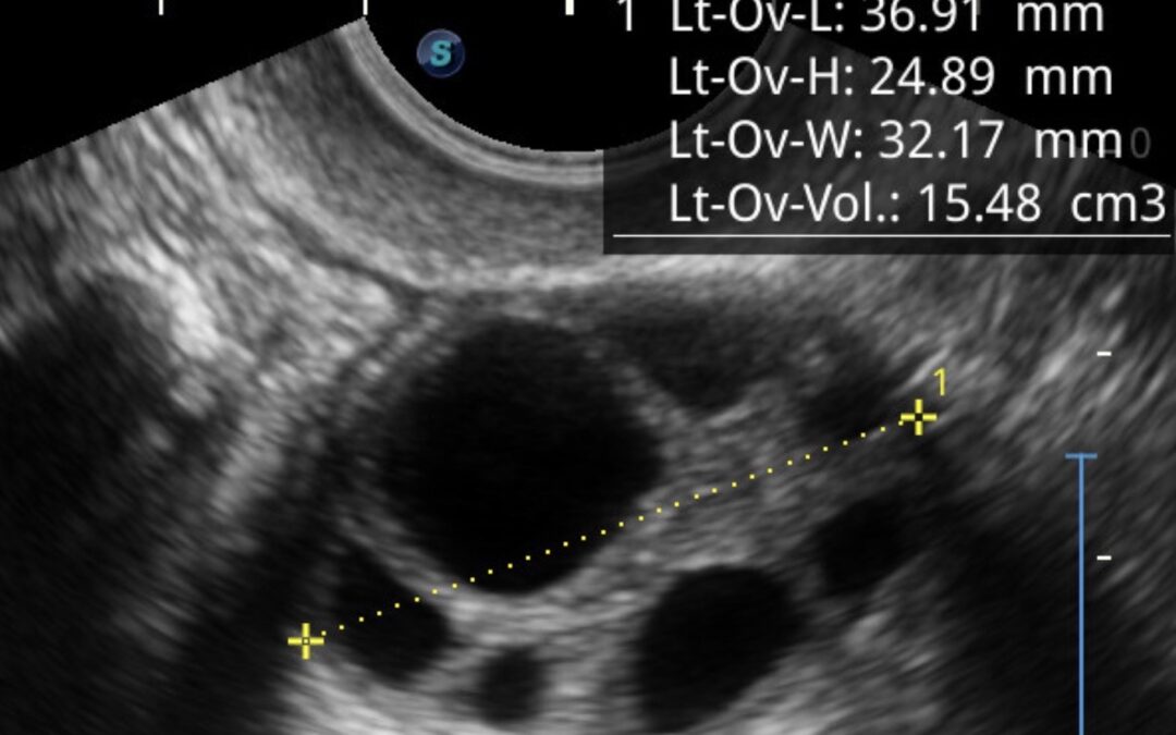 Síndrome de Ovarios Poliquísticos (SOP)