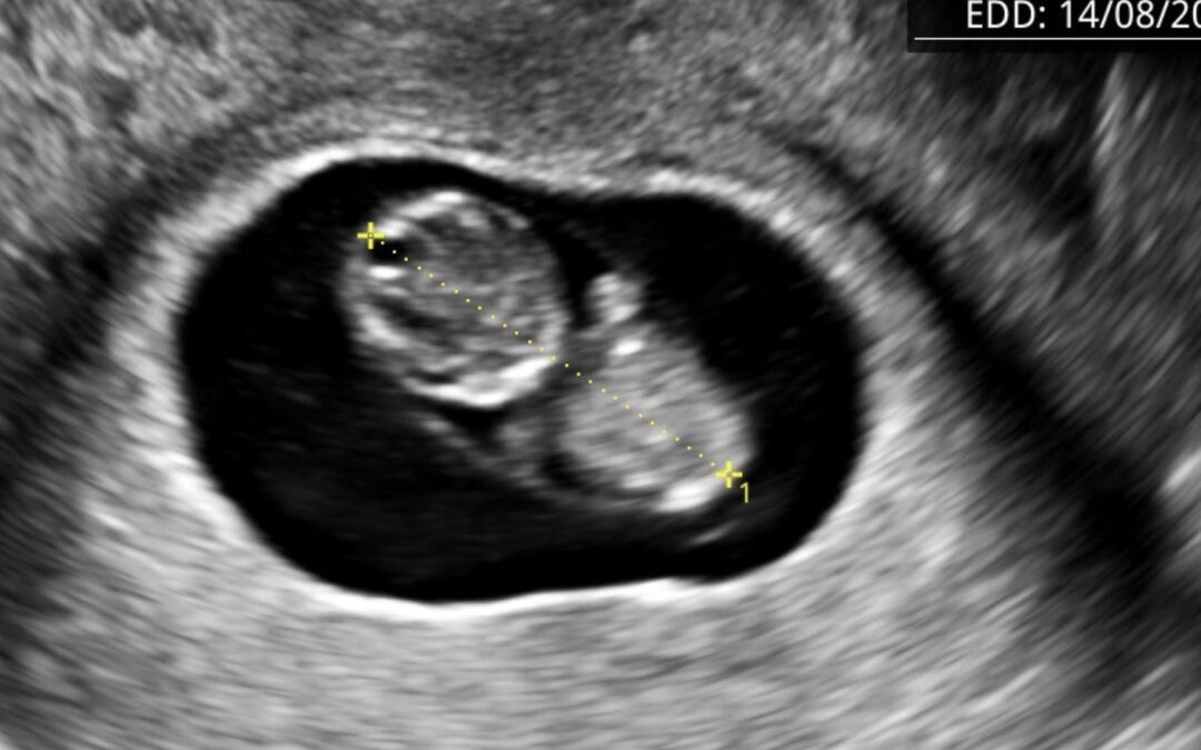 Aborto Recurrente: Causas y Tratamientos